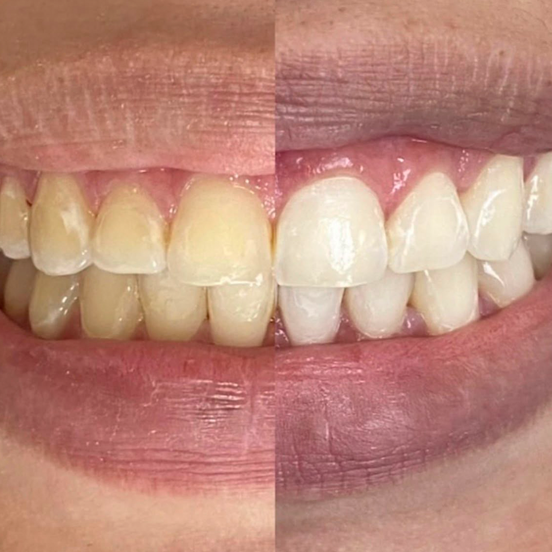 Clareamento dental — Dra. Carolina Teixeira