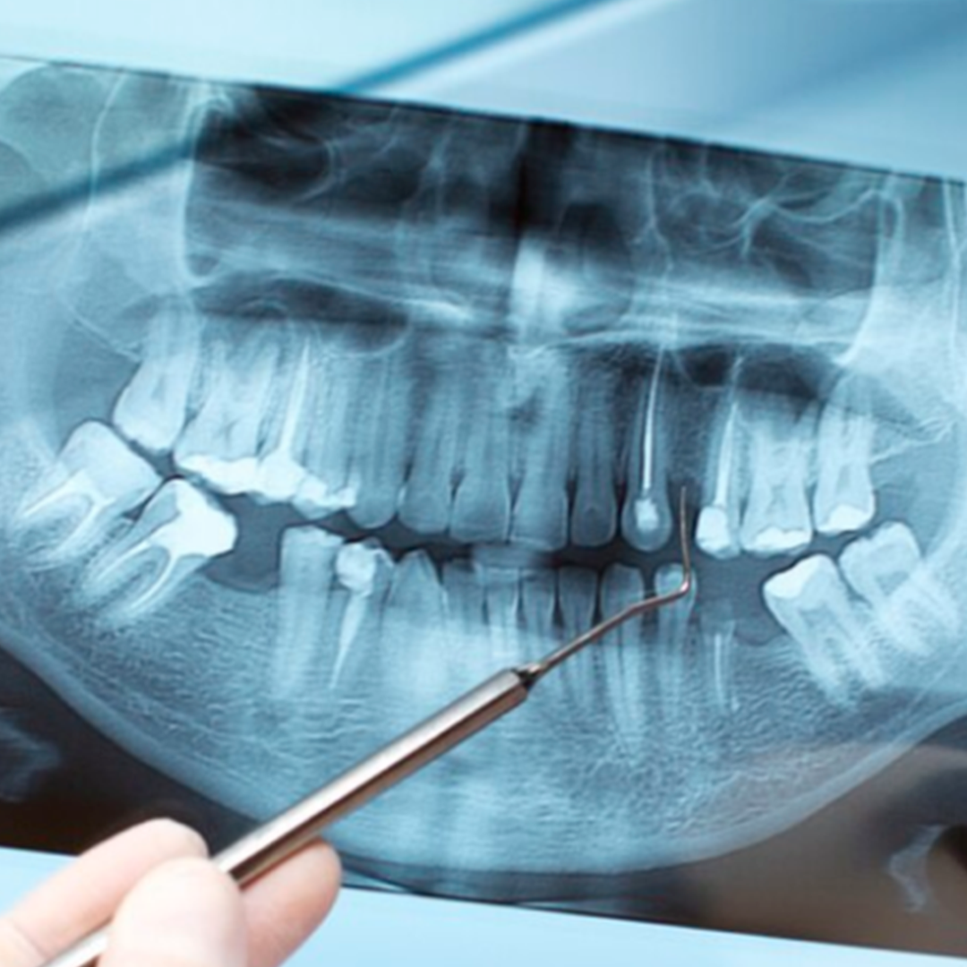 Endodontia, tratamento de canal — Dra. Carolina Teixeira