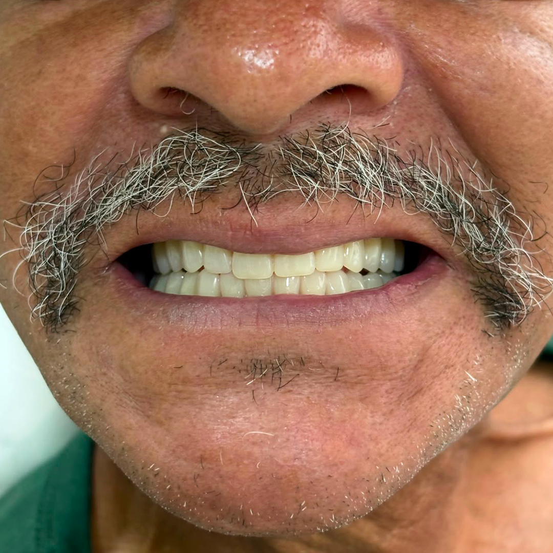 Implante dentário — Dra. Carolina Teixeira