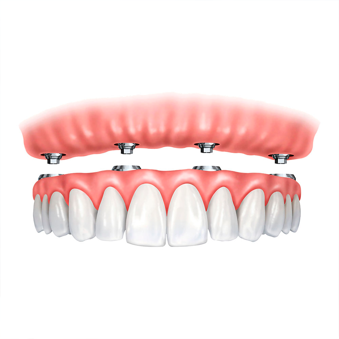 Prótese dentária e protocolo — Dra. Carolina Teixeira